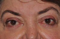 Droopy Upper Eyelids (Ptosis)