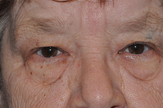 Droopy Upper Eyelids (Ptosis)