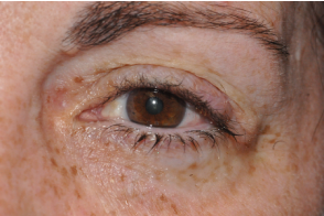 Eyelid Lesion