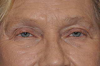 Droopy Upper Eyelids (Ptosis)