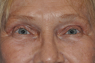 Droopy Upper Eyelids (Ptosis)