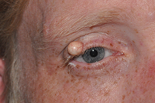 Droopy Upper Eyelids (Ptosis)