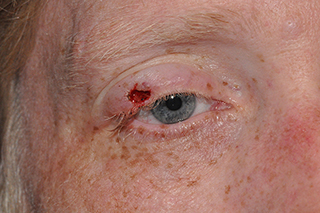 Droopy Upper Eyelids (Ptosis)