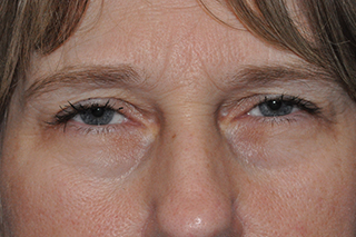 Droopy Upper Eyelids (Ptosis)