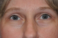 Droopy Upper Eyelids (Ptosis)