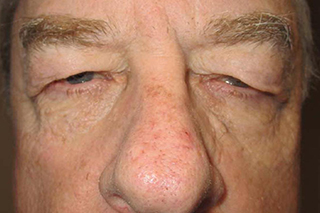 Droopy Upper Eyelids (Ptosis)