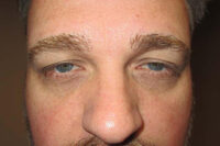 Upper Eyelid Lift or Blepharoplasty