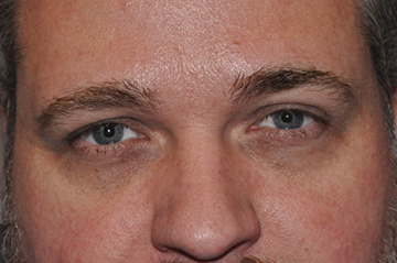 Upper Eyelid Lift or Blepharoplasty