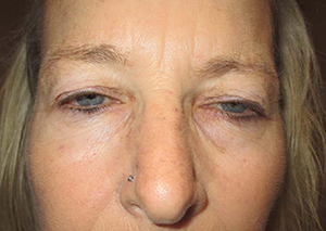 Droopy Upper Eyelids (Ptosis)