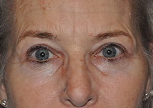 Droopy Upper Eyelids (Ptosis)