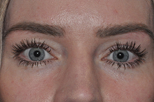 Upper Eyelid Lift or Blepharoplasty