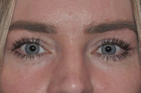 Upper Eyelid Lift or Blepharoplasty