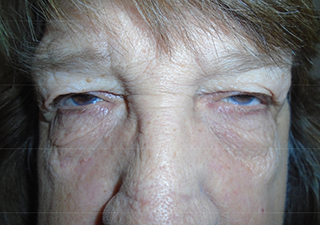 Droopy Upper Eyelids (Ptosis)