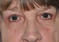 Droopy Upper Eyelids (Ptosis)