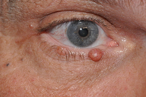 Eyelid Lesion