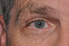 Eyelid Lesion