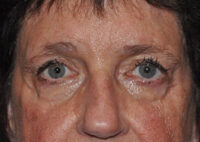 Eyebrow Lift or Forehead Lift