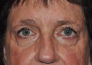 Eyebrow Lift or Forehead Lift